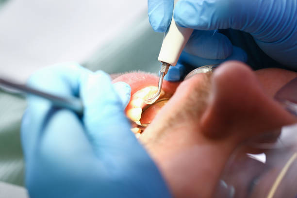 Best Emergency Dental Care for Broken or Chipped Teeth in Somersworth, NH